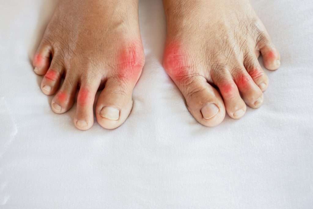 What Role Do Podiatrists Play in Managing Bunion Pain Effectively?