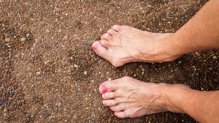 Hammertoe