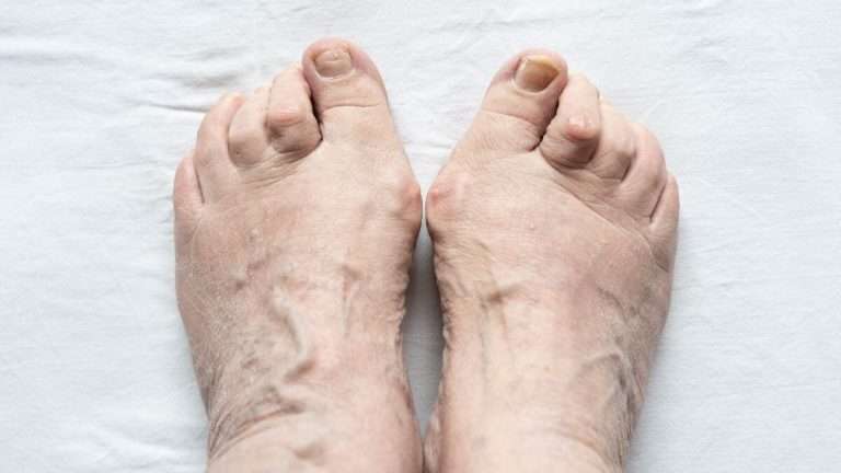 Hammertoe Treatment