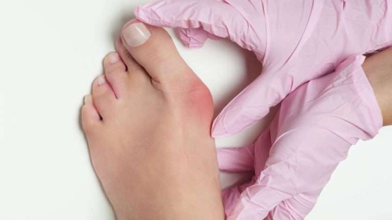 Bunions Can Cause Ball-of-Foot