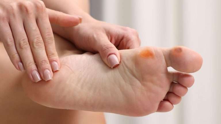 Toe-Tip Calluses Keep Returning With Hammertoes