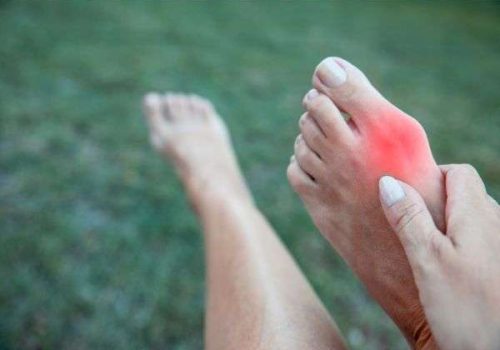 Female having Bunion Pain outdoors